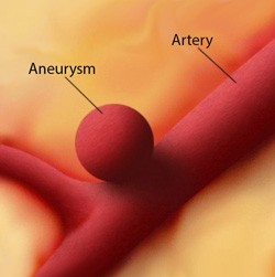 Brain aneurysm